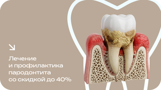 Лечение и профилактика пародонтита со скидкой до 40%