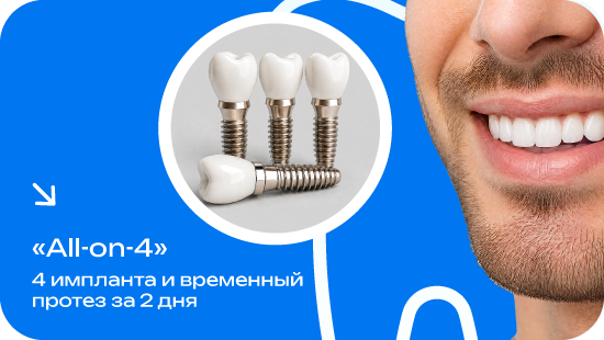 Имплантация зубов за 2 дня по технологии «All-on-4»