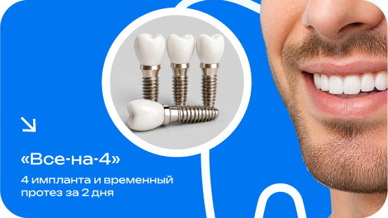 Имплантация зубов за 2 дня по технологии «All-on-4»