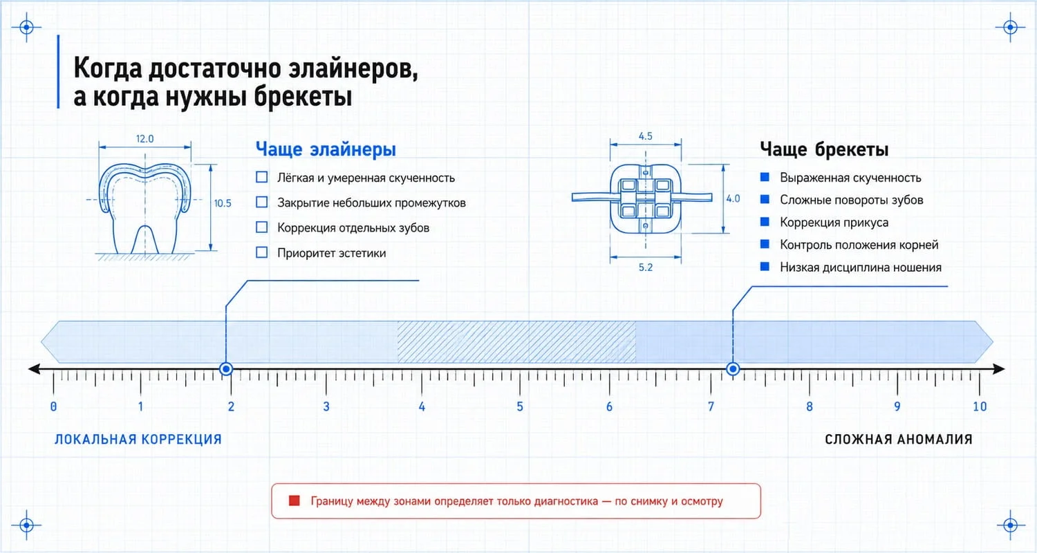 Когда выбирают элайнеры, а когда брекеты: шкала от локальной коррекции до сложных аномалий прикуса
