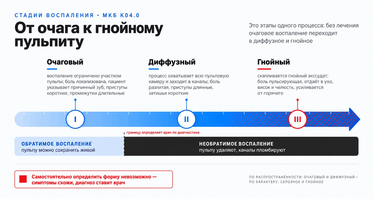 Виды острого пульпита: очаговый, диффузный и гнойный; обратимое и необратимое воспаление пульпы