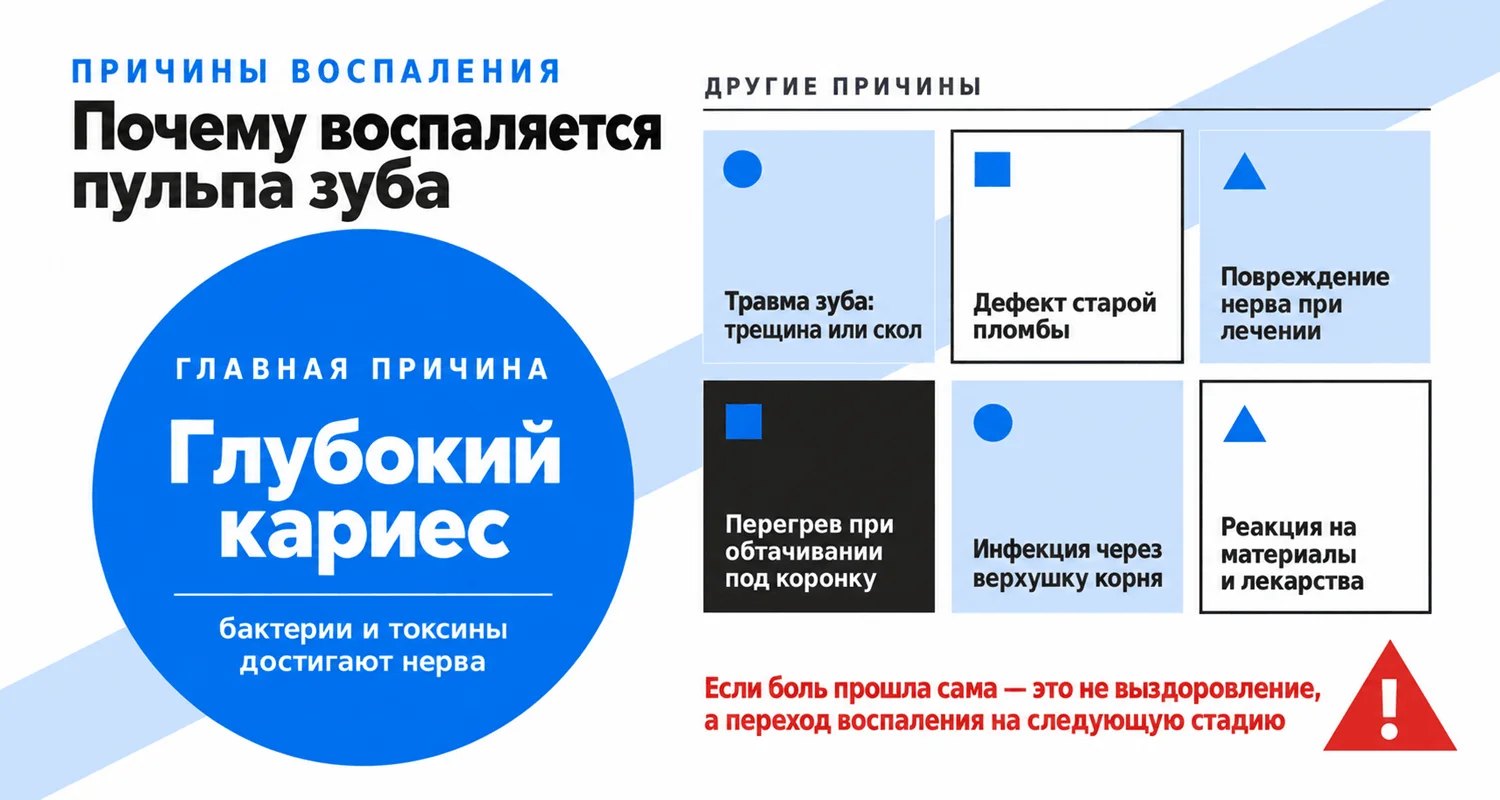 Причины острого пульпита: глубокий кариес как главная причина, травма зуба, дефект старой пломбы, повреждение нерва при лечении, перегрев при обтачивании, инфекция через верхушку корня