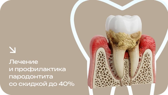 Лечение и профилактика пародонтита со скидкой до 40%