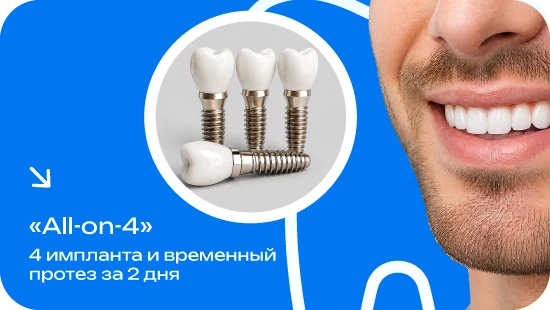 Имплантация зубов за 2 дня по технологии «All-on-4»